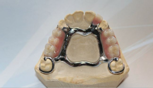 Cobalt Chrome Dentures 2