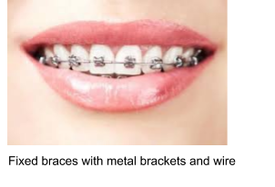 Fixed Metal Braces