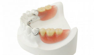 Cobalt Chrome Dentures 1