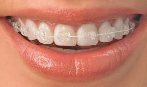 Cfast Braces