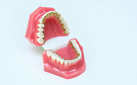 Lingual Braces