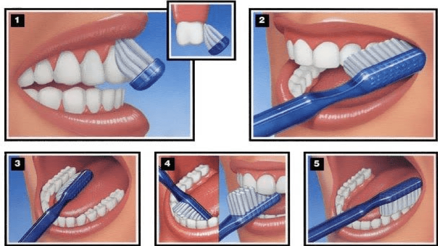 5 step diagram for brushing teeth effectively
