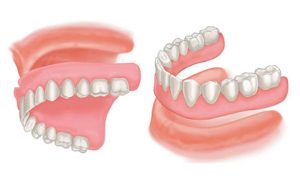 Diagram of top and bottom dentures, above gums