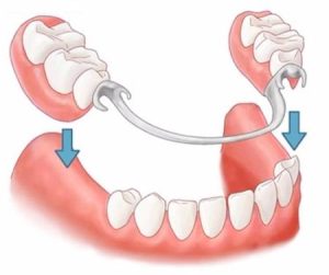 diagram of partial dentures with metal hooks over gums