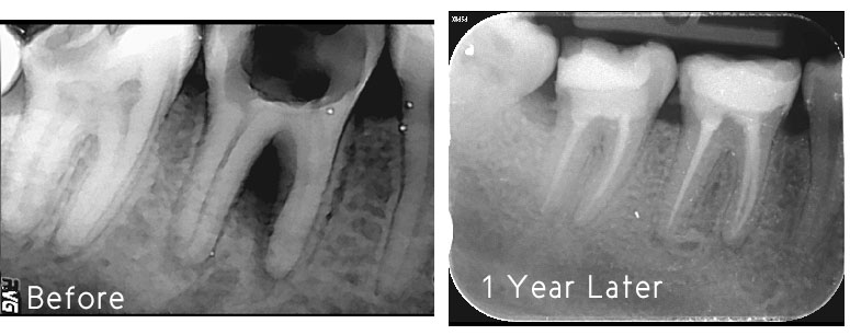 Before and after root canal treatment