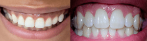2 close up photos of healthy gums, with varied skin/gum tones
