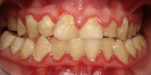 Closed teeth with tender red gums, a mouth with gum disease