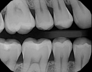 black and white X-ray image of teeth