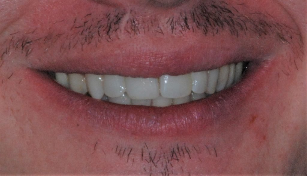 Cfast® Cosmetic Braces in Manchester The Vallance Dental Centre