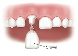 Crowns