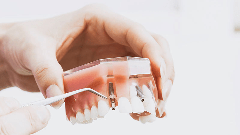 Dental Implants