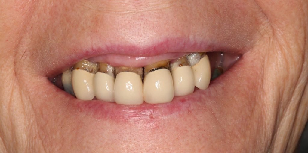 Types of Dentures A Comprehensive Guide The Vallance Dental Centre