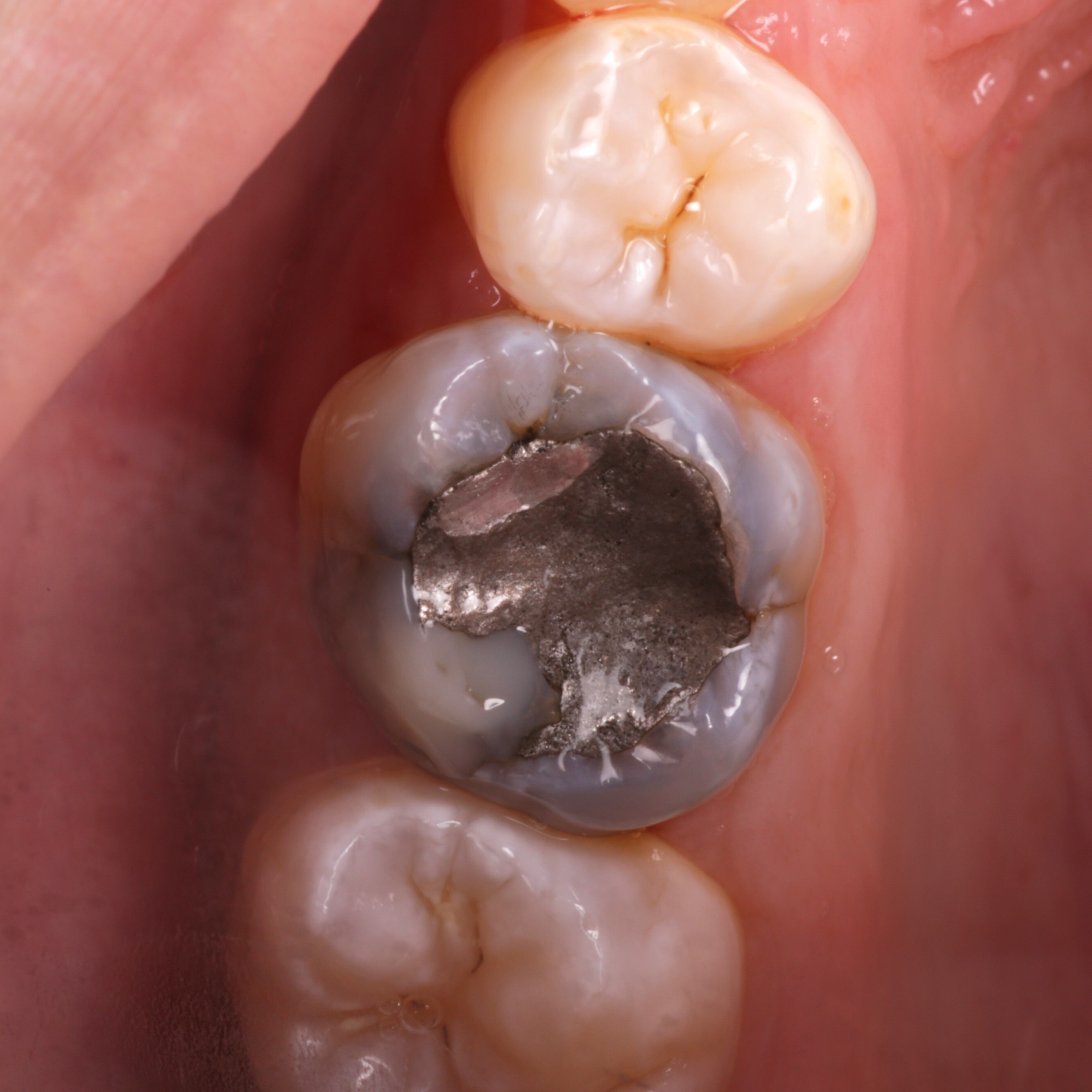 Amalgam - Before