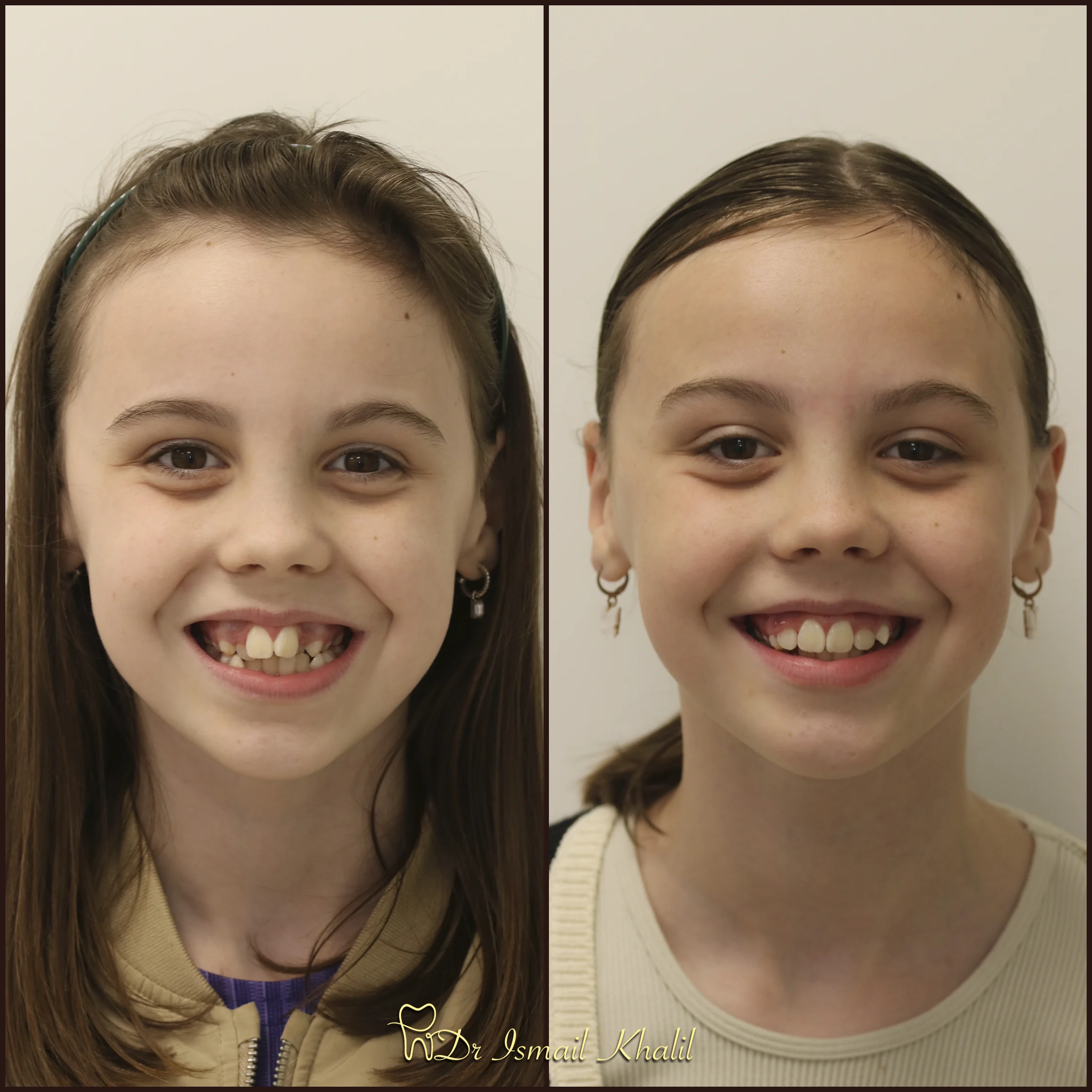 Child smile before and after fixed brace treatment