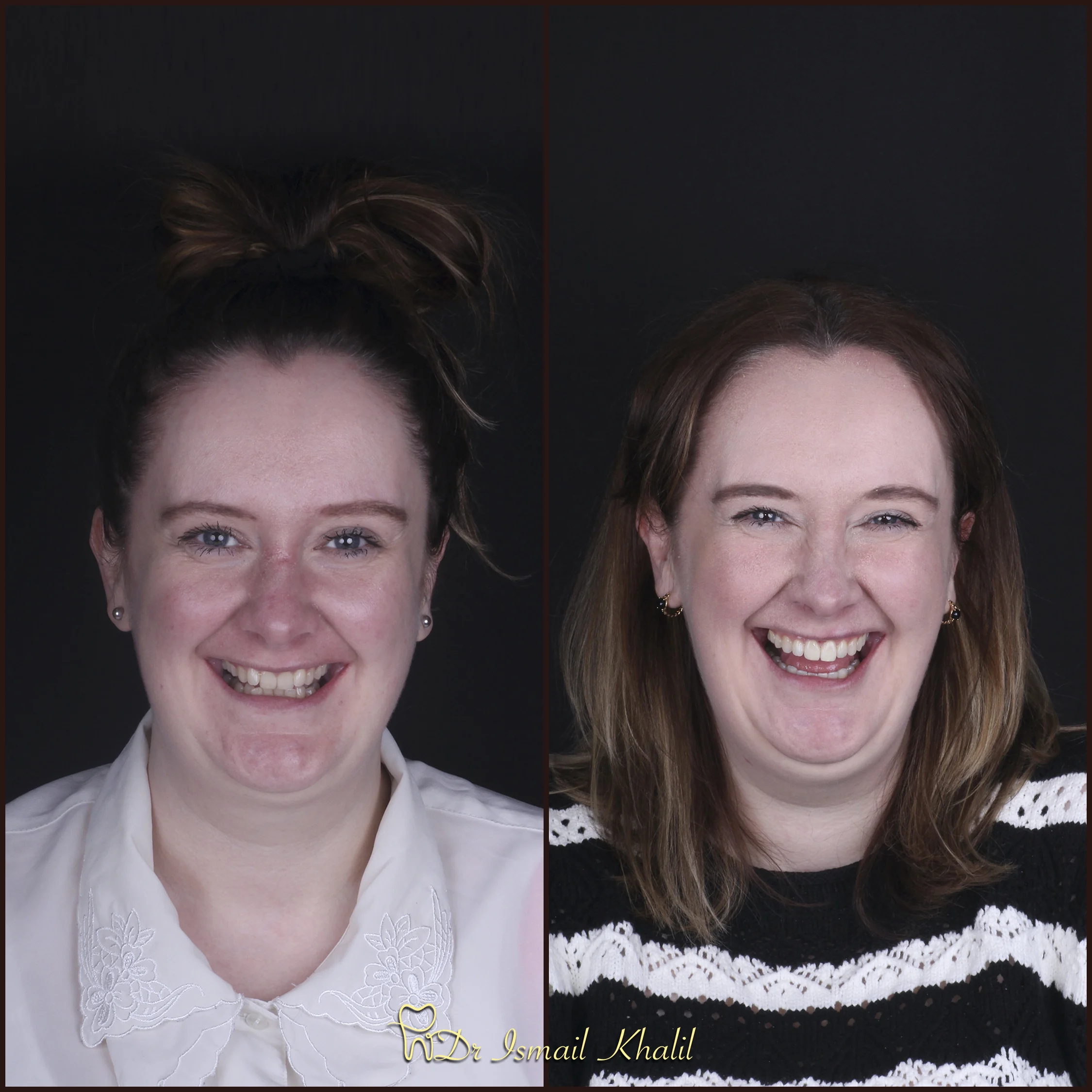 Adult smile before and after orthodontic treatment