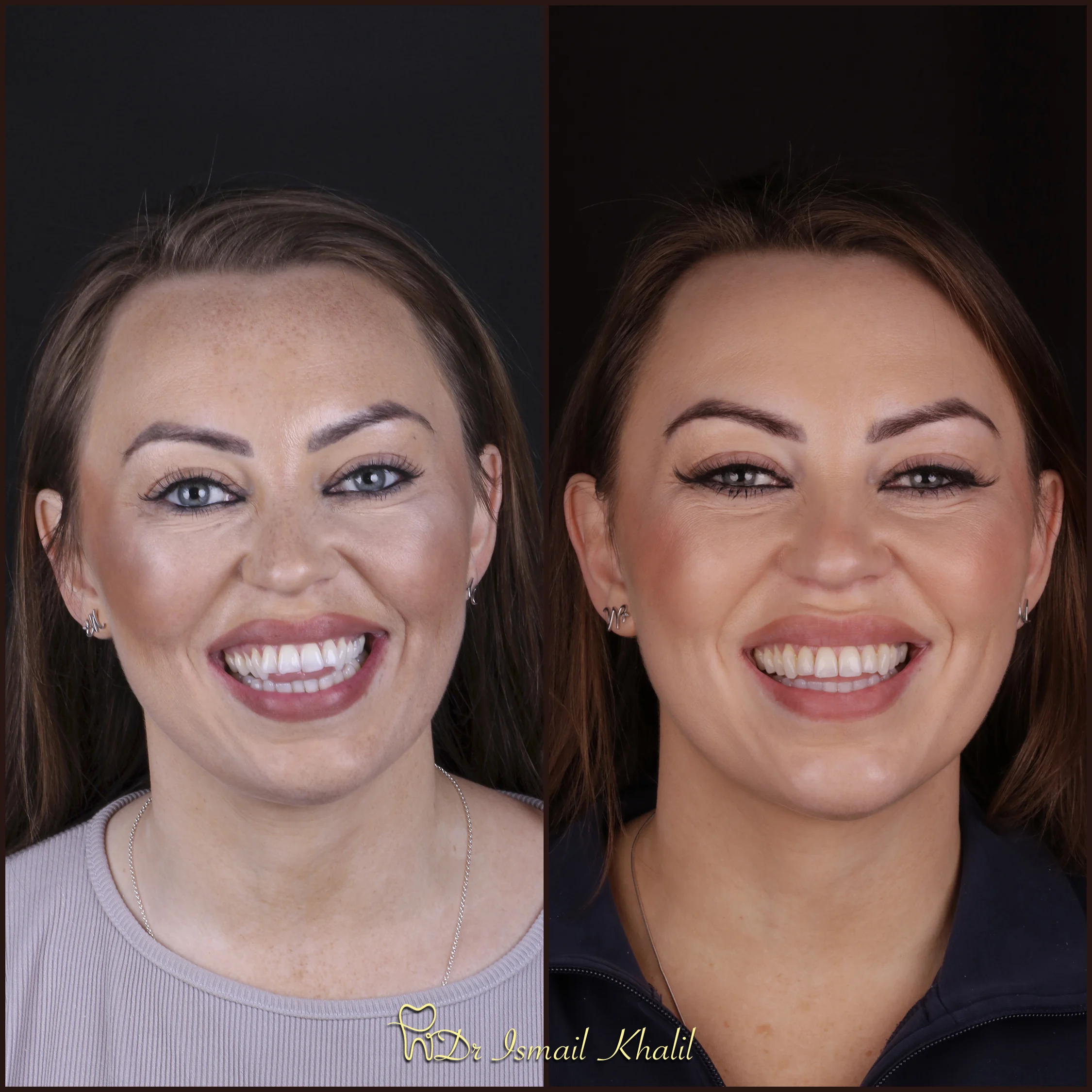 Adult smile before and after clear aligner treatment