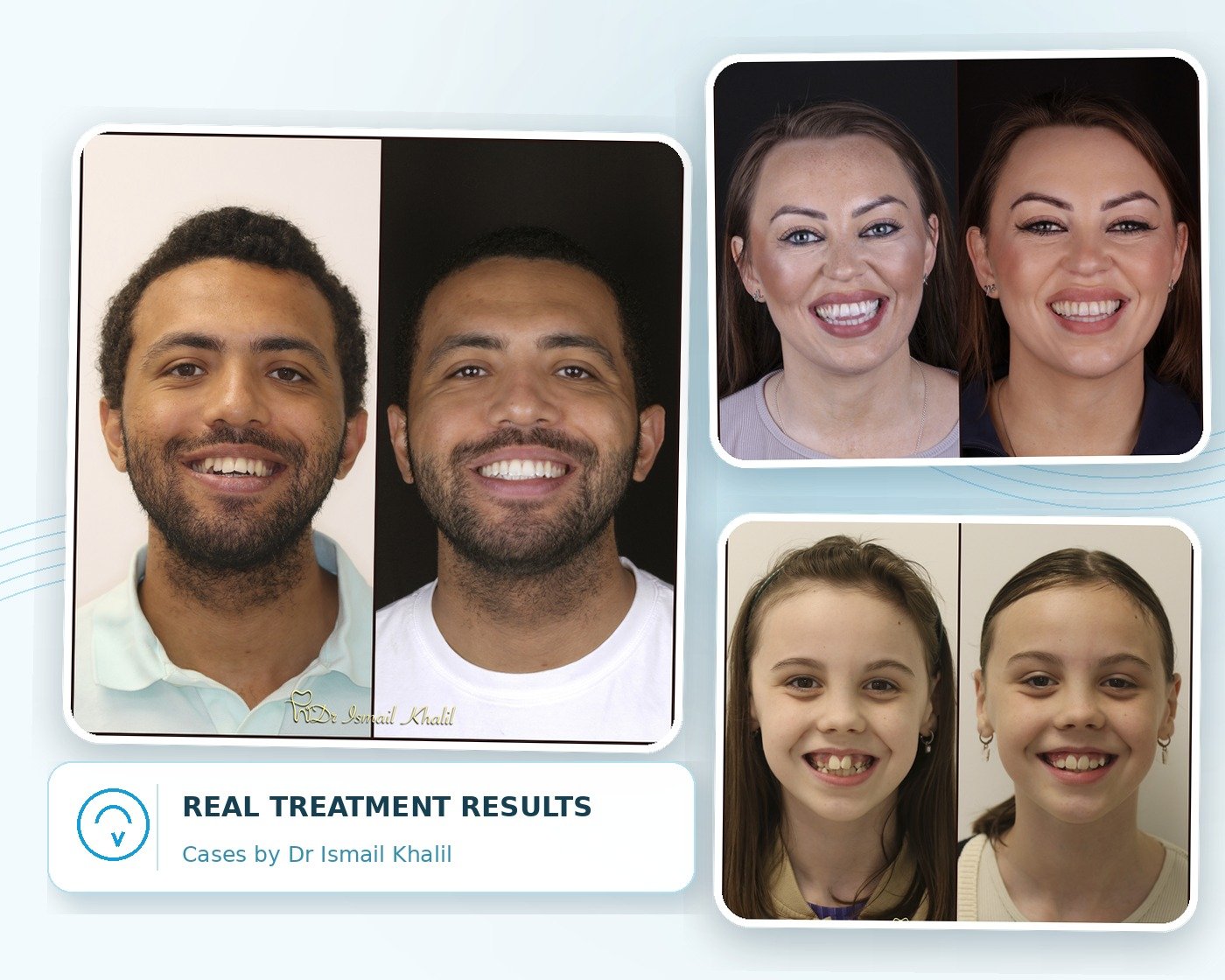 Real orthodontic treatment before-and-after results by Dr Ismail Khalil